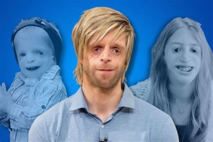 Famous Personalities Living With Treacher Collins Syndrome